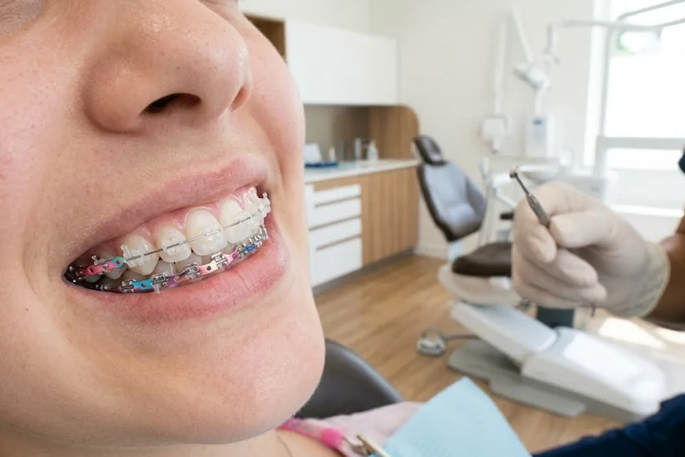 Orthodontic Braces