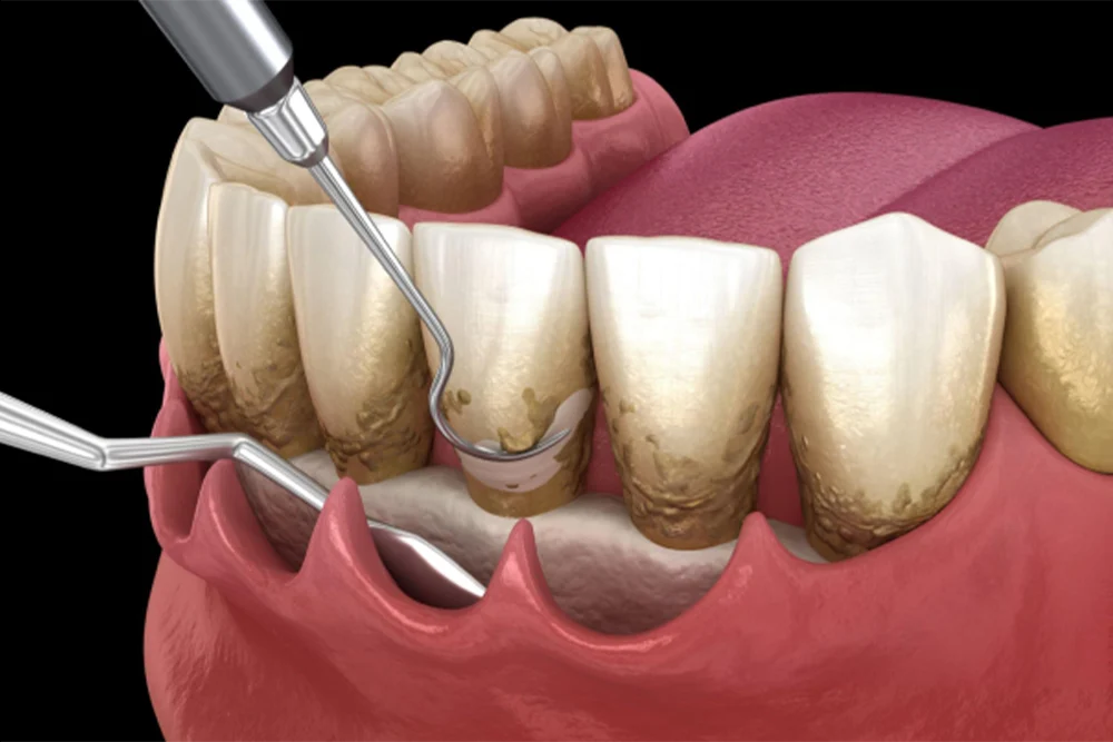 Periodontal Surgery
