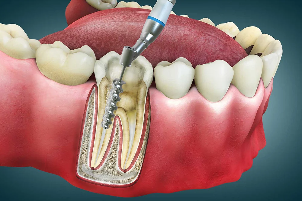 Root Canal Treatments