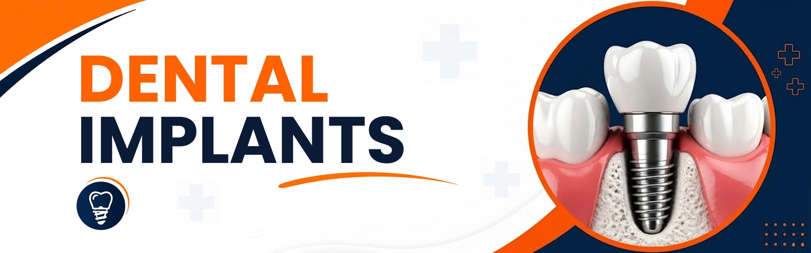 dental impalnts